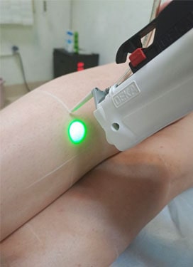 لیزر موهای زائد