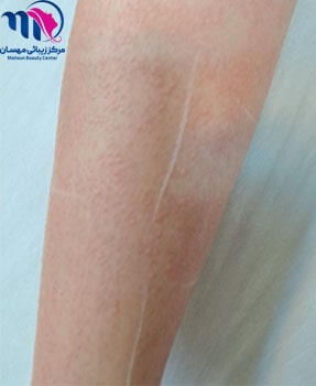 لیزر موهای زائد دست ها