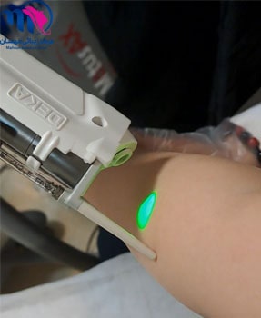 لیزر موی دست با دستگاه الکساندرایت دکا