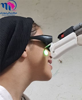 لیزر موی صورت