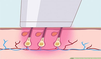 تعداد جلسات لیزر موهای زائد نواحی مختلف بدن